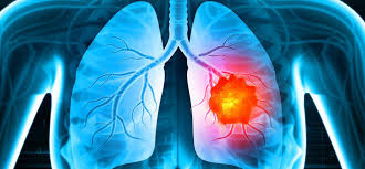 Lung cancer